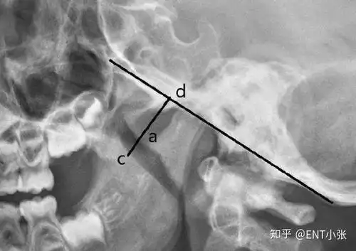 科普小朋友鼻炎打呼,可能是因为这个一文带你了解腺样体肥大