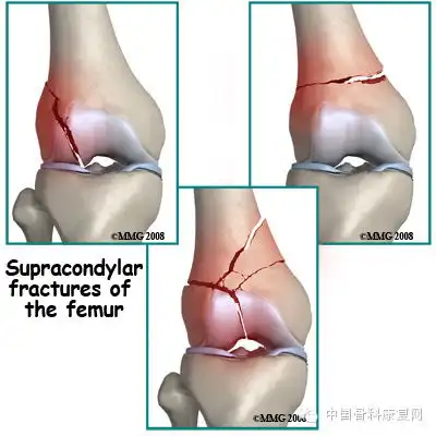 股骨远端骨折康复指南内附完整教学视频