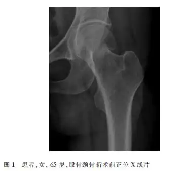 非移位型股骨颈骨折股骨头后倾角测量及对预后影响的研究进展