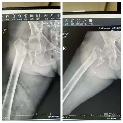 人生最后一次骨折股骨粗隆间骨折