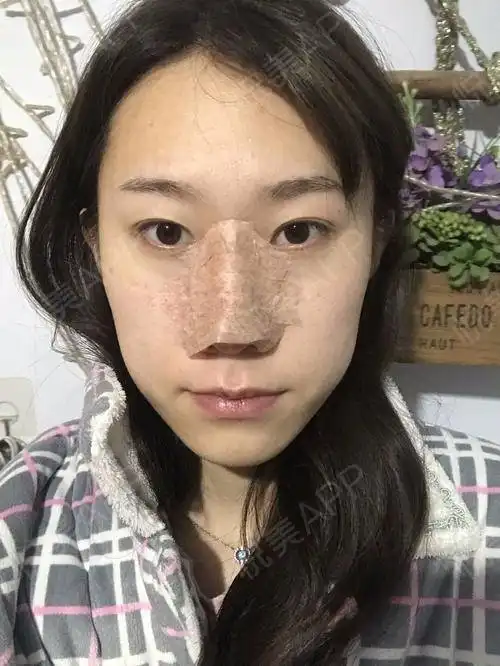 我来啦你们别看我面无表情,不苟言笑,其实我激动劲...垫鼻尖悦美整形
