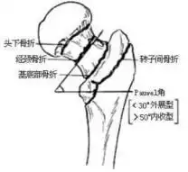 四肢骨折,你只知道是断手断脚,这里面学问不可不止这么一点