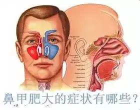 鼻甲肥大还不治疗小心失去嗅觉