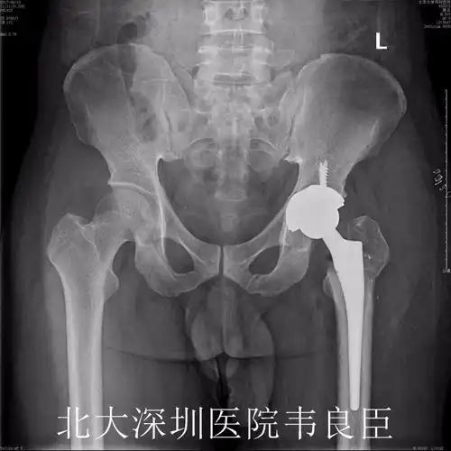 股骨颈骨折髋臼骨折术后股骨头坏死行髋关节置换病例x片