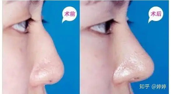 隆鼻和鼻综合的区别在哪该怎么选择