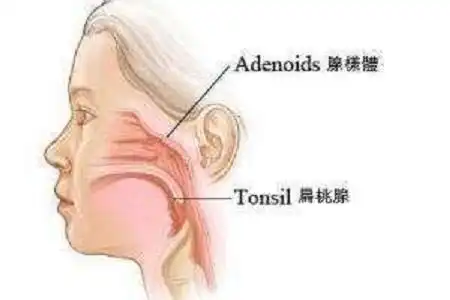 首大石萍小孩腺样体肥大易被忽略应早发现早诊治