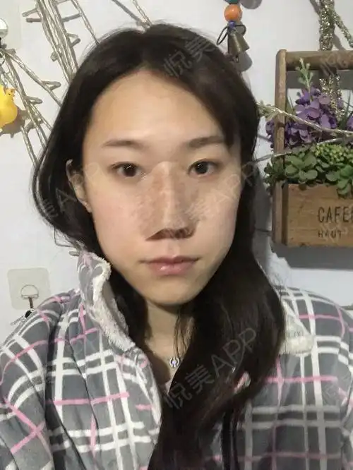 我来啦你们别看我面无表情,不苟言笑,其实我激动劲...垫鼻尖悦美整形